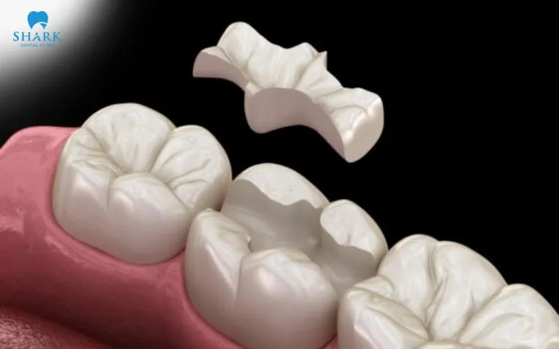 At the next appointment, the dentist will permanently bond the filling piece onto your tooth and re-check your bite