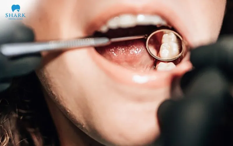 The cost of a porcelain tooth filling is typically higher compared with other tooth filling methods due to a number of different factors that influence the final price