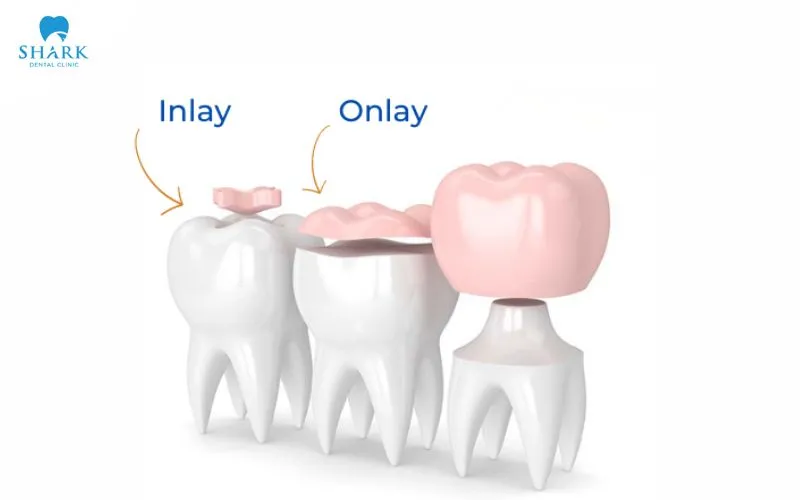Porcelain inlay and onlay techniques are both forms of indirect restoration, custom-fabricated outside of the mouth before being bonded onto the tooth