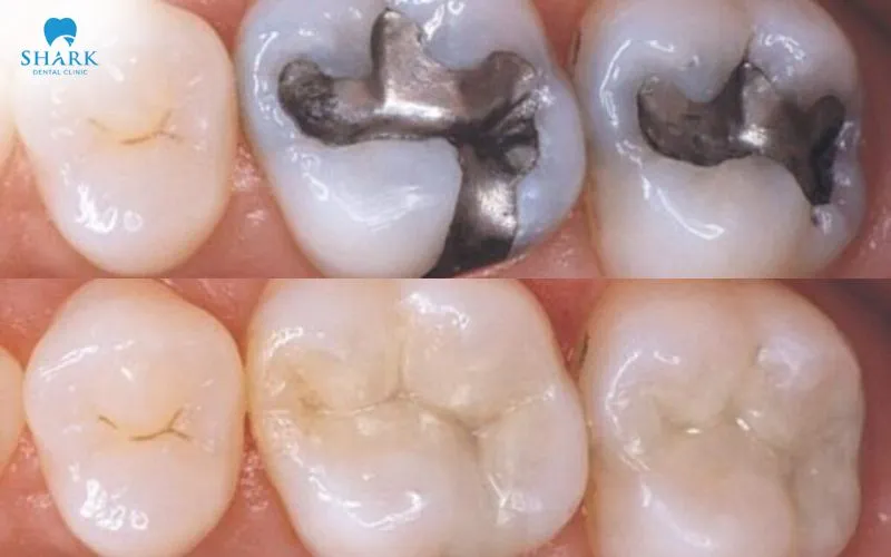 A porcelain filling piece has a color and optical characteristics that closely resemble those of natural teeth, and it can provide suitable strength for selected cases, depending on the material, restoration design, and location of the tooth.