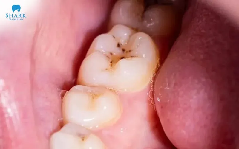 This particular technique is not suitable for small cavities or areas of the tooth that only have mild wear or minor damage