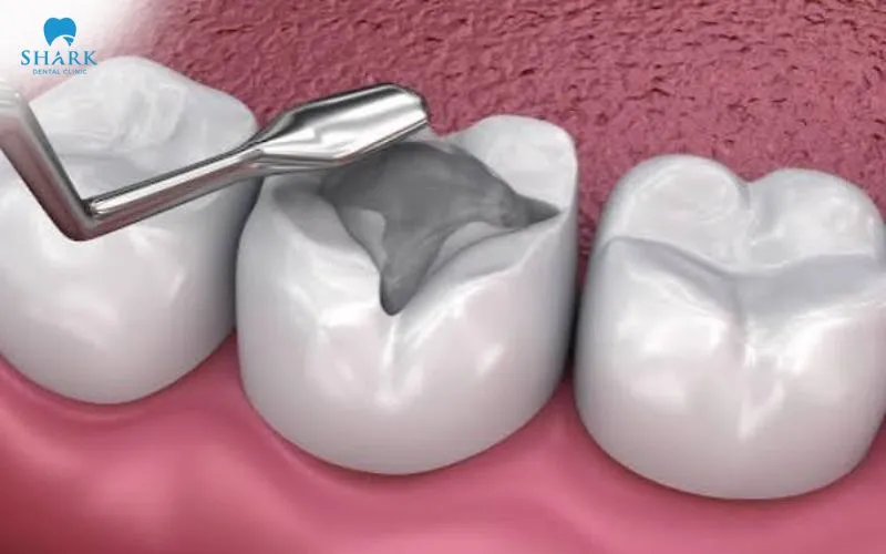 Composite fillings are typically suitable for small to medium-sized cavities, particularly in positions that are easily visible