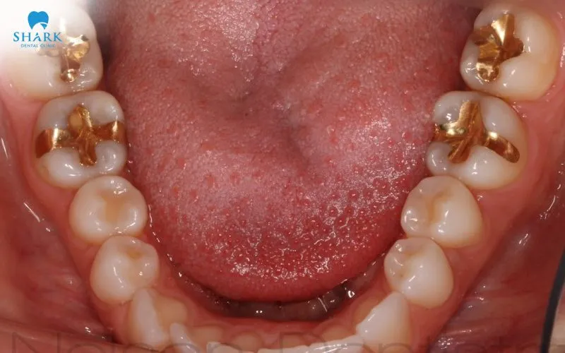 Gold fillings are highly regarded for their long-term durability if they are properly cared for