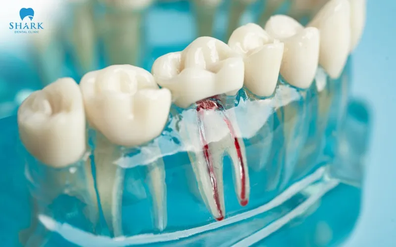 This method suits those people whose root canal system is relatively straight and is not overly narrow or complex