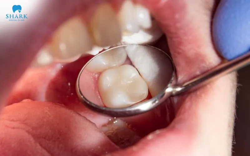 After the root canal treatment, the dentist fills and seals the canal so that bacteria are not able to make their way back in