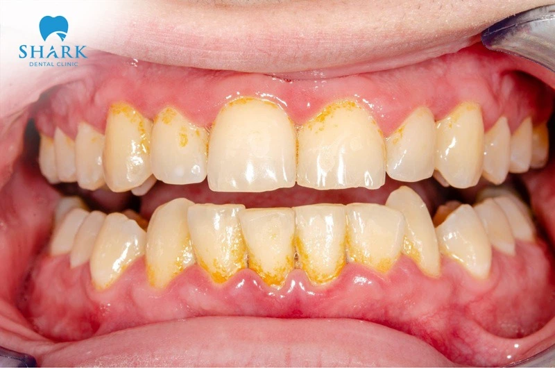 Built-up plaque and tartar deposits are a common cause of discoloration, and they can prevent the tooth surface from turning white even after a whitening treatment has already been carried out