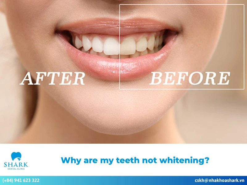 Why are my teeth not whitening? Common causes and how to fix it