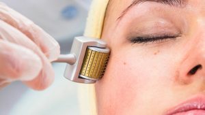           Lăn kim trị mụn là phương pháp làm đẹp khá phổ biến hiện nay