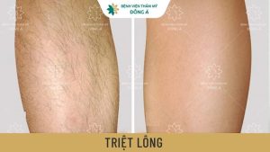 Hiệu quả triệt lông cao tại Thẩm mỹ viện Đông Á
