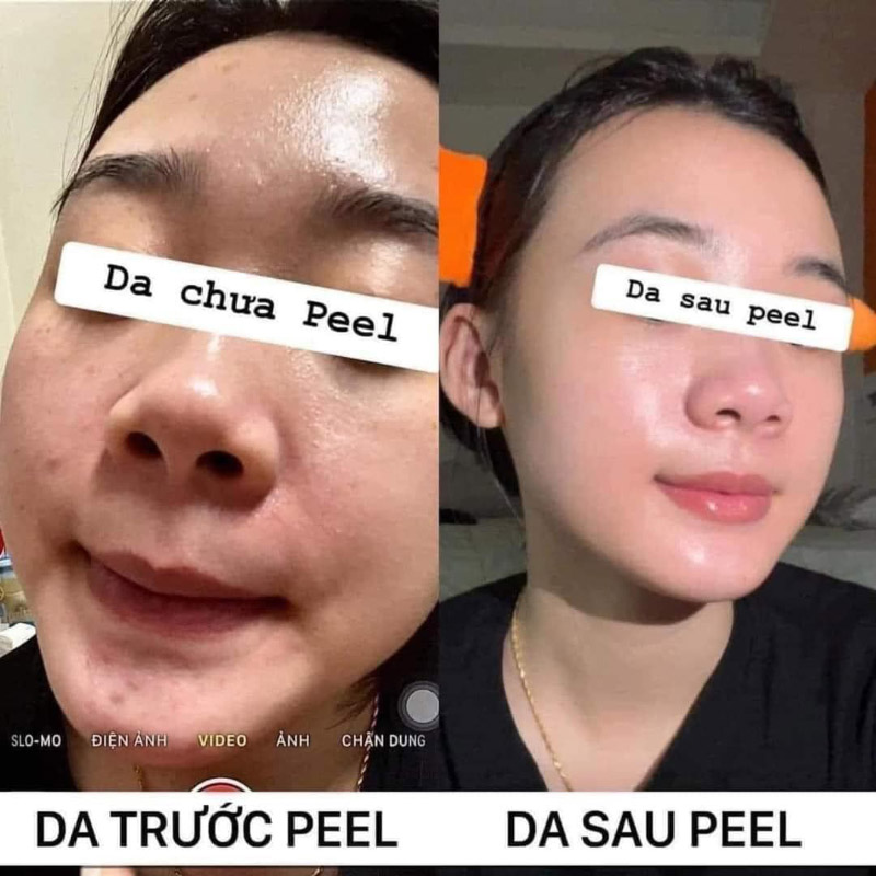 Khách hàng trị mụn tận gốc, lấy lại làn da mịn màng tại Spa Bùi Lê