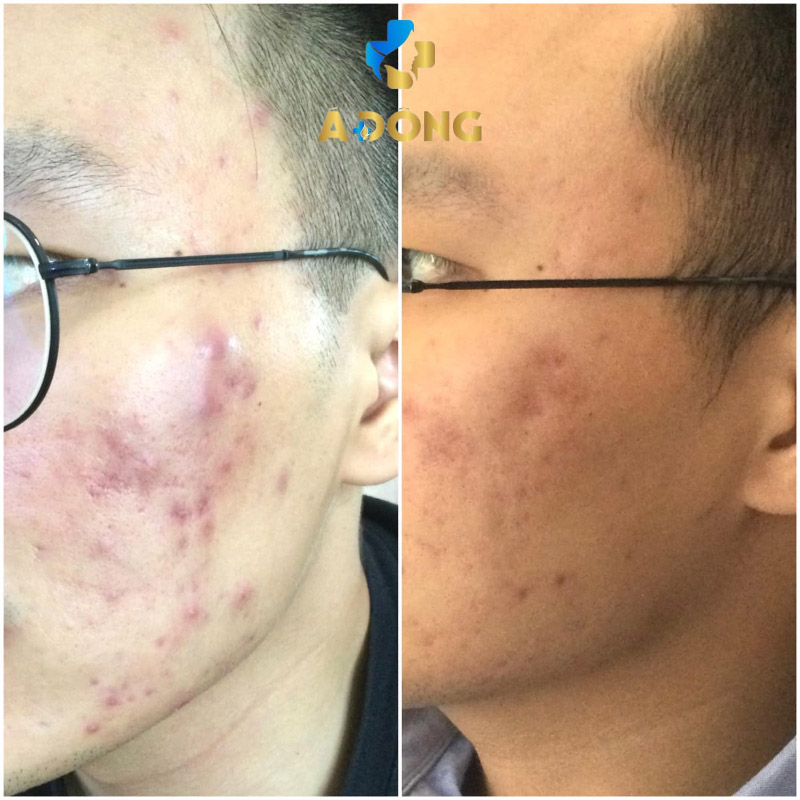 Khách hàng tận hưởng dịch vụ trị mụn hiện đại tại Thẩm mỹ viện Á Đông