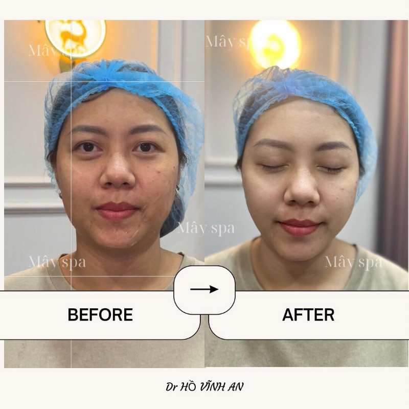 Khách hàng điều trị mụn chuẩn Y khoa tại Mây Spa - Phòng khám da liễu xủa Bs. Hồng
