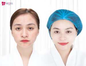 Công nghệ trị mụn Dr. Ance độc quyền giúp lấy lại làn da mịn màng cho khách hàng nhanh chóng