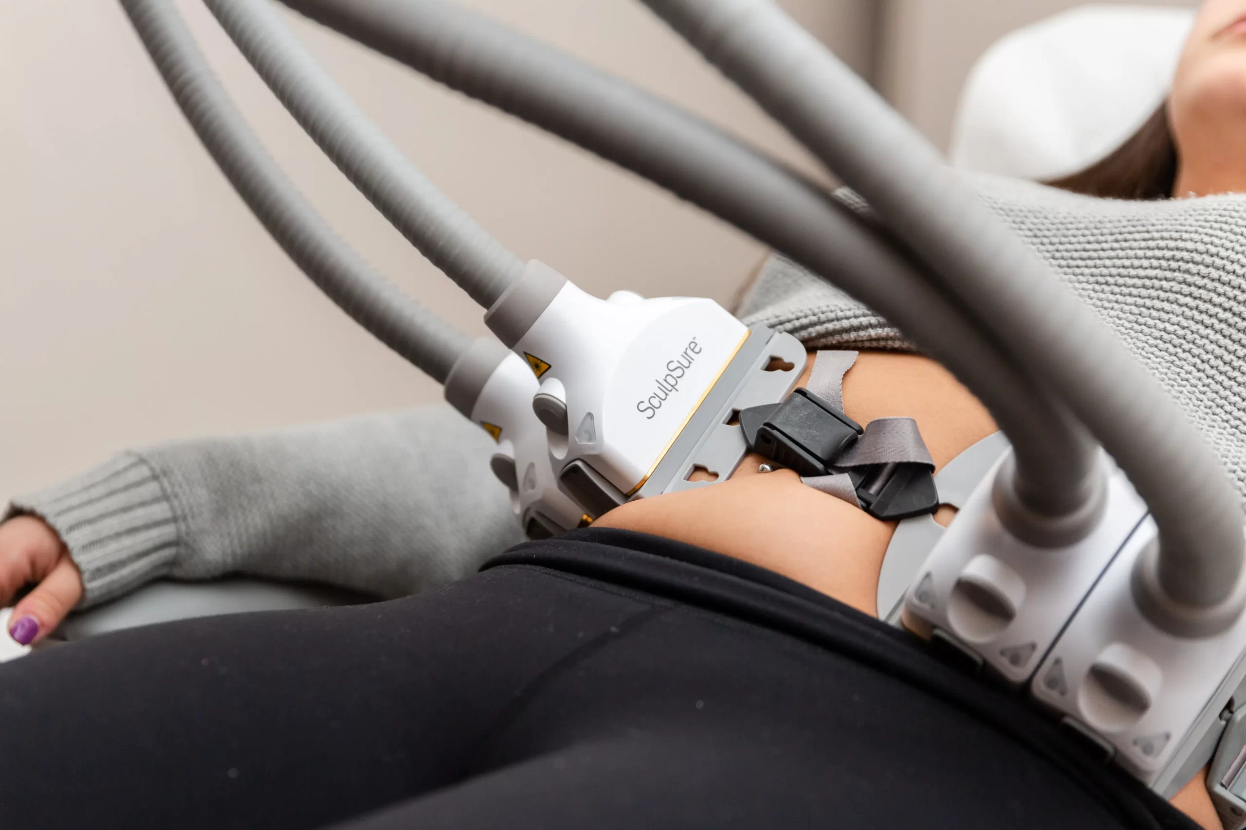 Cryolipolysis sử dụng cơ chế làm lạnh có kiểm soát để tác động vào lớp mỡ dưới da tại vùng điều trị.