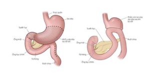 Quy trình phẫu thuật cắt dạ dày và kỳ vọng hiệu quả