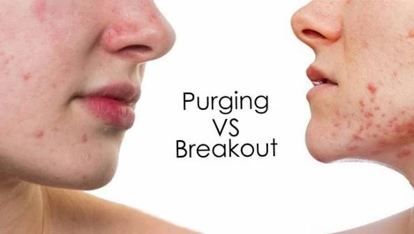 Biểu hiện và tính chất nốt mụn khác gì?