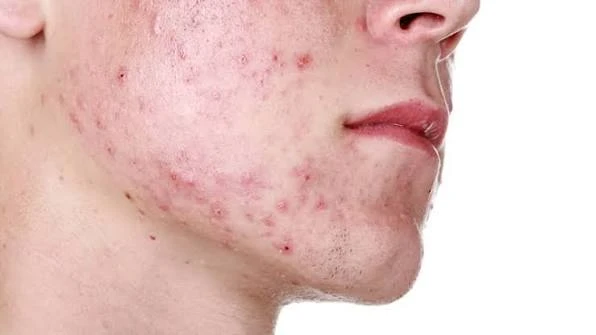 Làm sao dùng retinoid an toàn hơn để giảm purging?