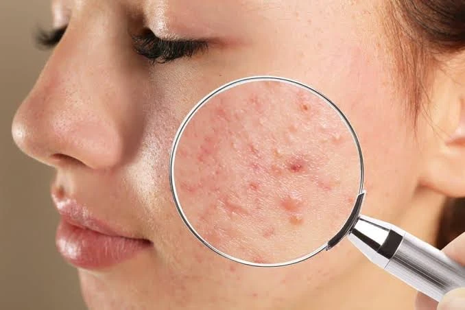 Khoảng thời gian để skin purging kết thúc là bao lâu?