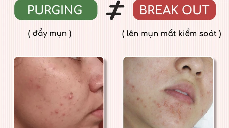 Vị trí mụn nổi lên khác nhau thế nào?