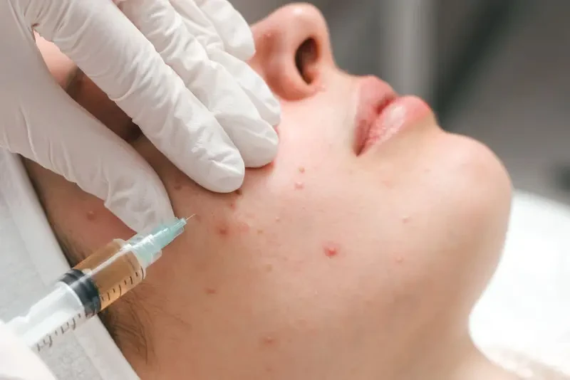 Meso trị mụn và cơ chế tiêm vào da