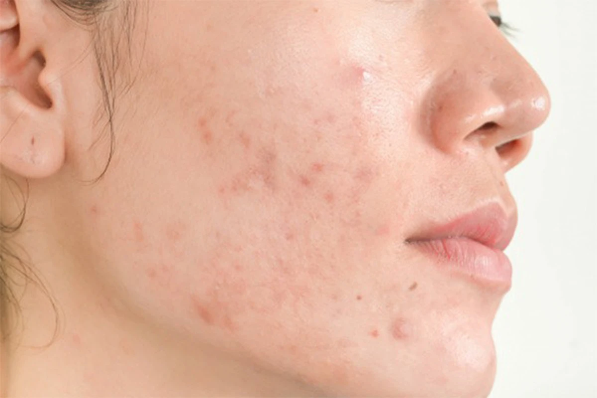 Vì sao da bị đỏ rát sau peel?