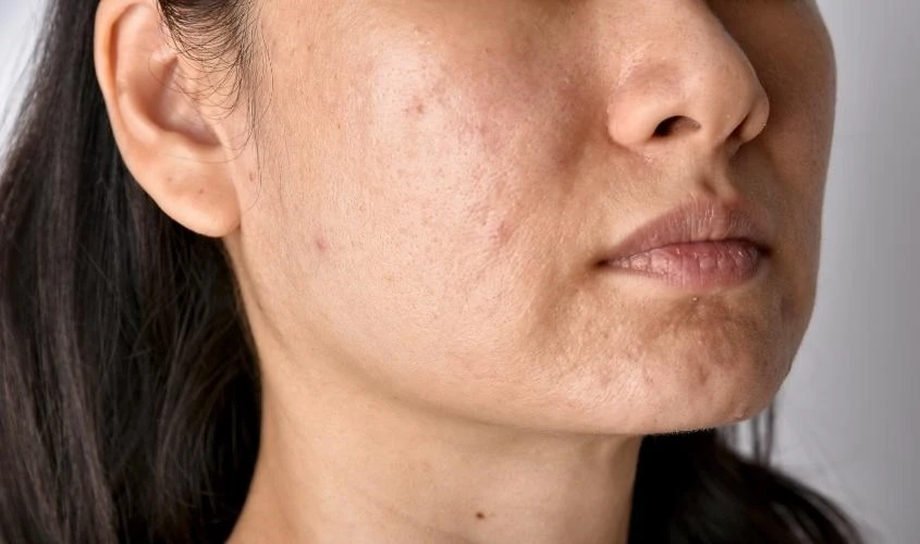 Mụn ẩn là gì và tại sao nó hình thành sâu dưới da