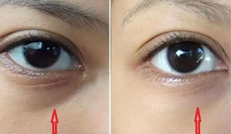 Bao lâu thì thấy kết quả và cách phòng ngừa