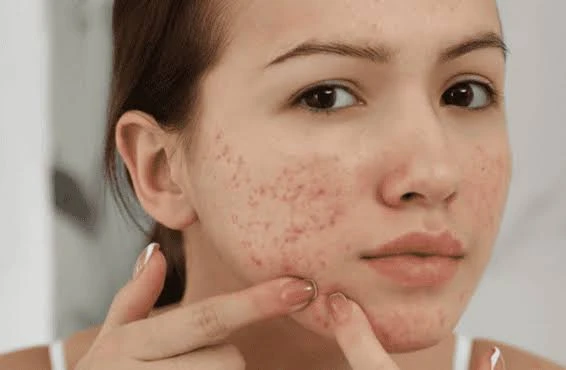 Những hiểu lầm phổ biến về mụn ẩn là gì