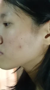 cystic acne deep under skin