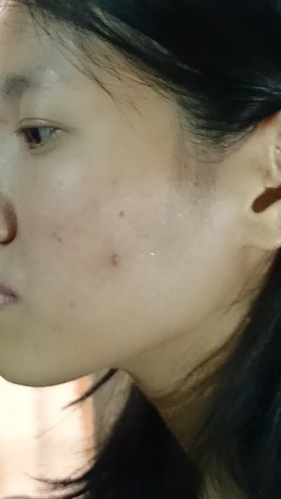 cystic acne deep under skin
