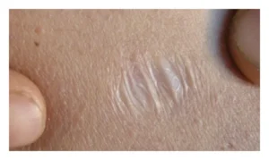 atrophic scars pitted scars scar treatment acne scars scar revision
