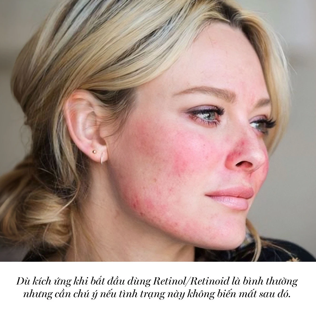 Khi nào nên giảm liều hoặc tạm ngừng retinol?