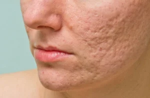 Chi phí điều trị sẹo rỗ bao nhiêu tiền