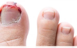 Móng chân bị tổn thương do va chạm với vật thể cứng