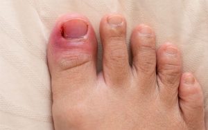 Cách dưỡng móng chân bị hư là câu hỏi được nhiều chị em quan tâm