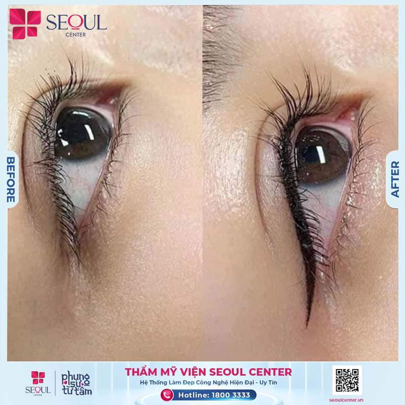 Thẩm mỹ viện Seoul Center nổi bật với việc ứng dụng nhiều công nghệ hiện đại trong phun mí