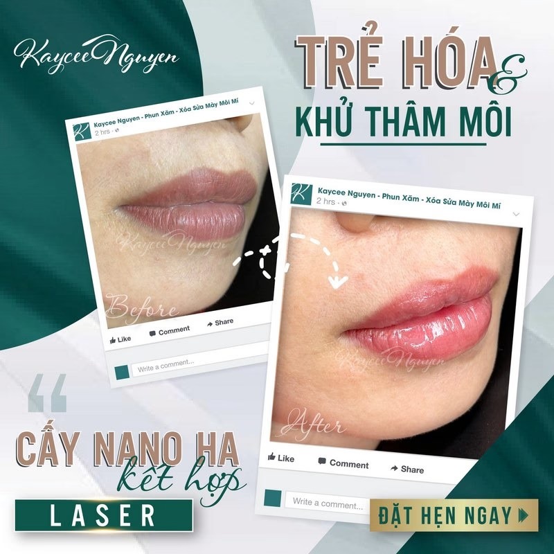 Kacee Nguyen nổi bật trong việc ứng dụng công nghệ Hàn Quốc vào phun môi