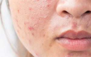 Da sẽ bị tổn thương sau khi nặn mụn