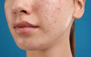 Da xuất hiện các nốt mụn thâm đỏ