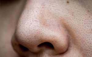 Mụn đầu đen thường đi kèm với lỗ chân lông to