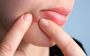 Mụn sau khi được xử lý sẽ để lại vết thương trên da