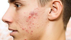 Có rất nhiều các loại mụn trên mặt