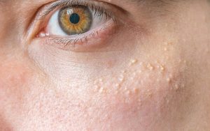 Mụn thịt thường xuất hiện tại vùng mắt