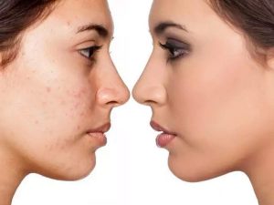 Hình 1 -  Da mặt sần sùi làm diện mạo kém thẩm mỹ