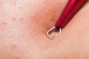 Mụn bọc phải chín và trồi lên mới dễ dàng xử lý và không để lại sẹo rỗ, thâm mụn