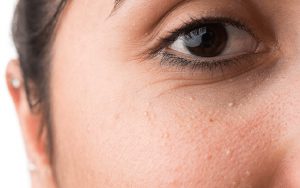 Mụn thịt ở vùng mắt