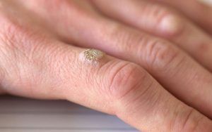 Mụn cóc có vẻ ngoài mất thẩm mỹ và chúng có tốc độ lây lan cực kỳ nhanh