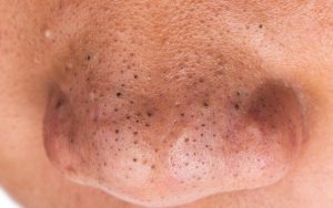 Mụn đầu đen gây mất thẩm mỹ