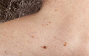 Có rất nhiều nguyên nhân gây nên mụn thịt ở cổ