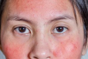 Mụn trứng cá có thể bị đỏ nếu kích ứng